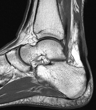 Figure 1 for case Achilles tendon tear and calcaneonavicular coalition (RID3801)(RID3184)